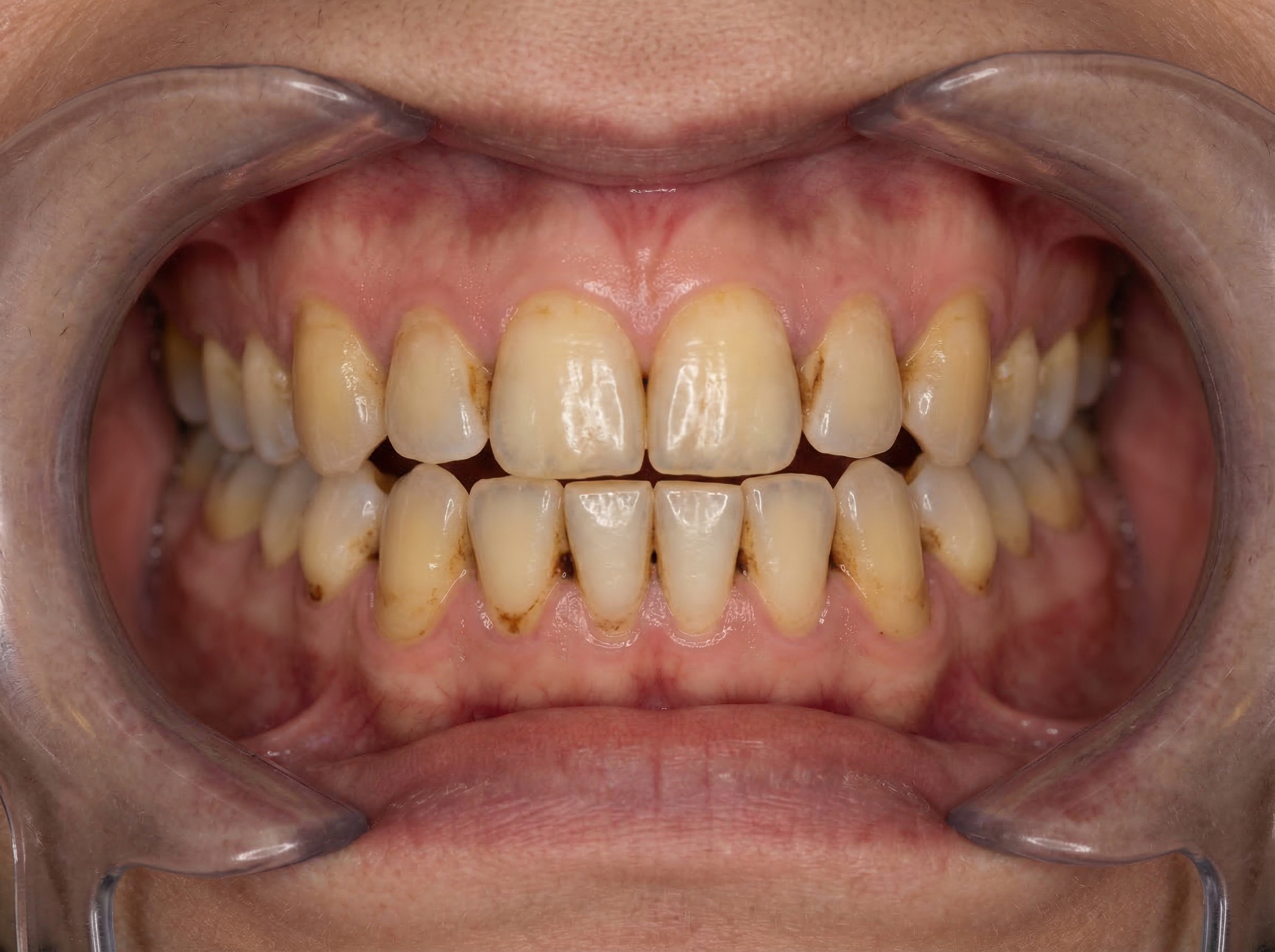 Before whitening treatment