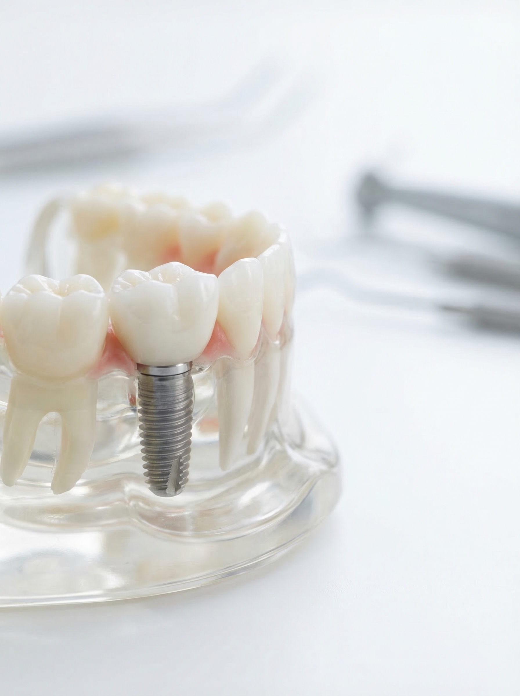 Dental Implants